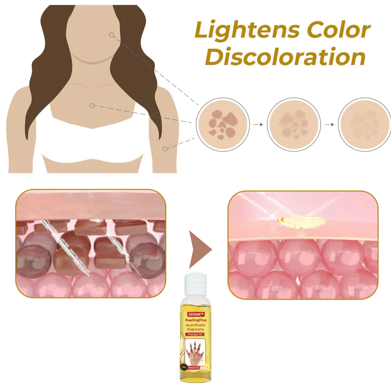 GFOUK™ PeelingPlus Acanthosis Nigricans Therapy Oil - Image 4