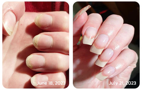 flysmus™ OnycholysisHeal Nail Strengthening And Growth Conditioner - Image 6