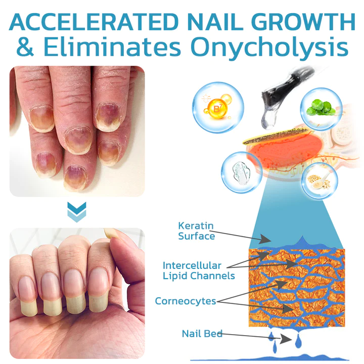 flysmus™ OnycholysisHeal Nail Strengthening And Growth Conditioner - Image 4