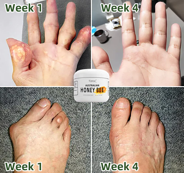 Cvreoz™ Australian Honey Bee Venom Pain and Bone Healing Cream - Image 3