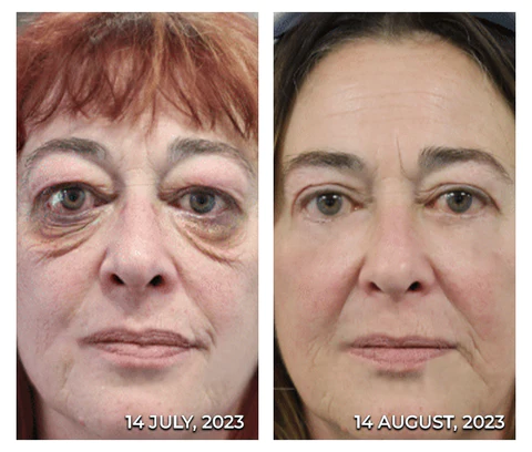 Furzero™ 24K Gold Snail Firming Eye Patches - Image 2