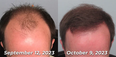 GFOUK™ EvolveGRO Far Infrared Light Hair Therapy Cap