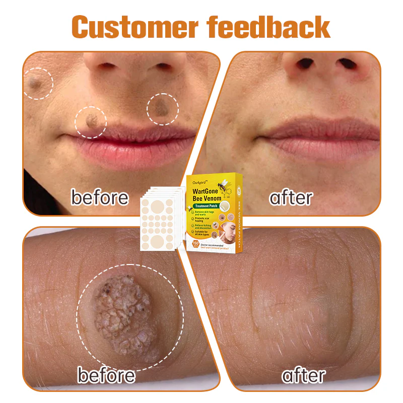 Ourlyard™ WartGone Bee Venom Treatment Patch - Image 2