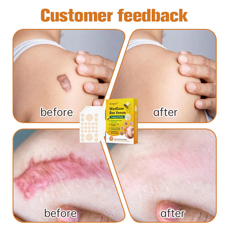 Ourlyard™ WartGone Bee Venom Treatment Patch - Image 3