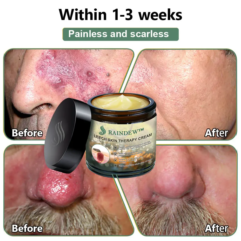 RAINDEW™ Leech Skin Treatment Cream