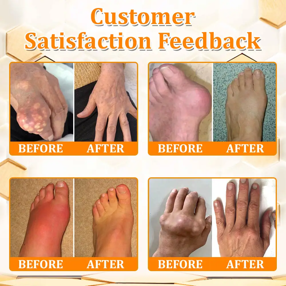 flysmus™ Bee Venom Advanced Pain-Relief & Bone Healing Cream