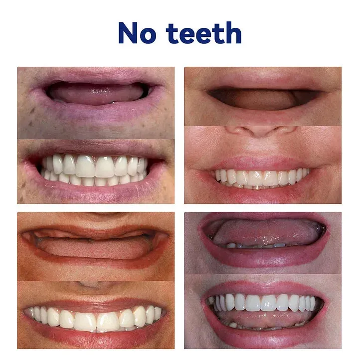 Lekdas™-🦷Advanced Customized Full Denture Set - Image 7