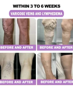 HONXI™ Куркума и масло от ему Противовъзпалителни перли за отслабване на краката