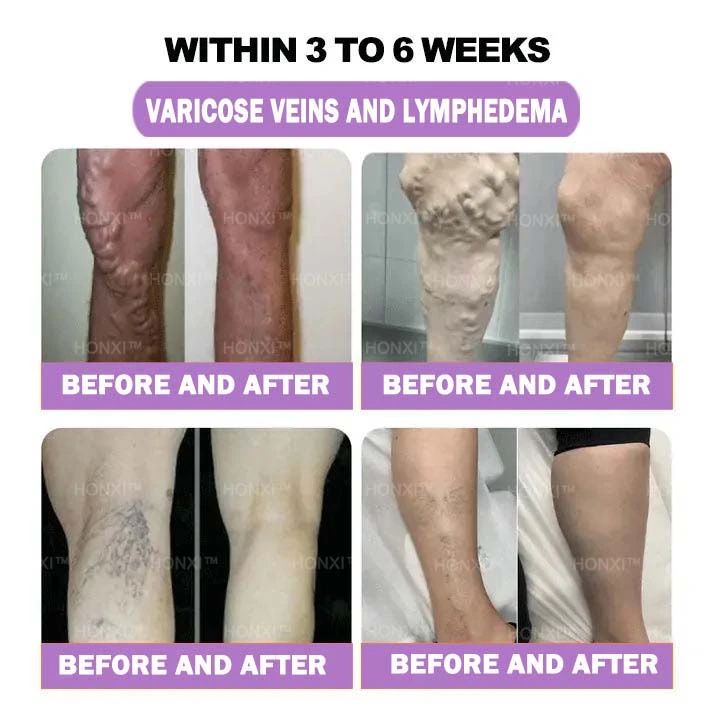 HONXI™ Куркума и масло от ему Противовъзпалителни перли за отслабване на краката