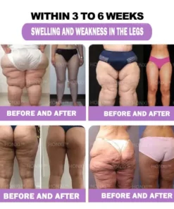 HONXI™ Куркума и масло от ему Противовъзпалителни перли за отслабване на краката