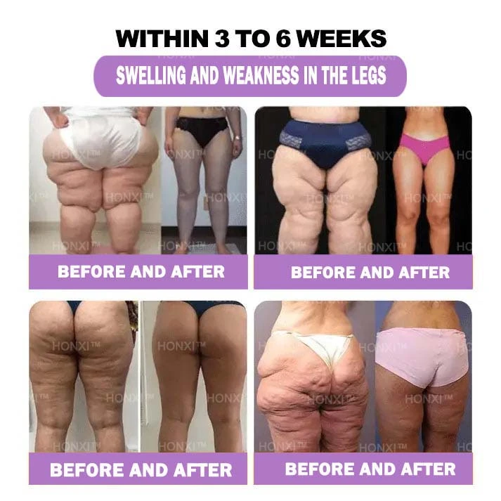 HONXI™ Куркума и масло от ему Противовъзпалителни перли за отслабване на краката