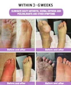 HONXI™ Куркума и масло от ему Противовъзпалителни перли за отслабване на краката