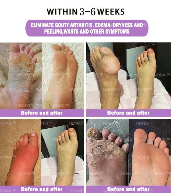 HONXI™ Куркума и масло от ему Противовъзпалителни перли за отслабване на краката