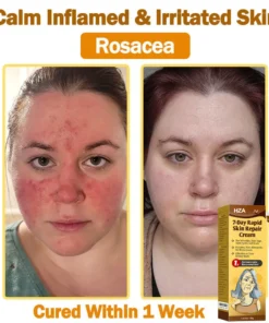 HZA®𝟕-𝐃𝐚𝐲 𝐑𝐚𝐩𝐢𝐝 𝐒𝐤𝐢𝐧 𝐑𝐞𝐩𝐚𝐢𝐫 𝐂𝐫𝐞𝐚𝐦