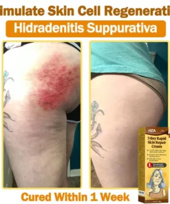 HZA®𝟕-𝐃𝐚𝐲 𝐑𝐚𝐩𝐢𝐝 𝐒𝐤𝐢𝐧 𝐑𝐞𝐩𝐚𝐢𝐫 𝐂𝐫𝐞𝐚𝐦