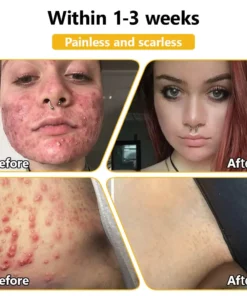 HZA™ Bee Toxin Skin Treatment Cream