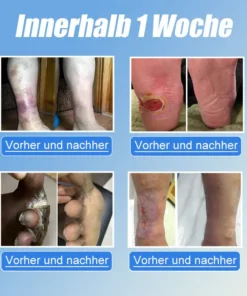 JORONDY® VitaGluco Diabetes Treatment Cream