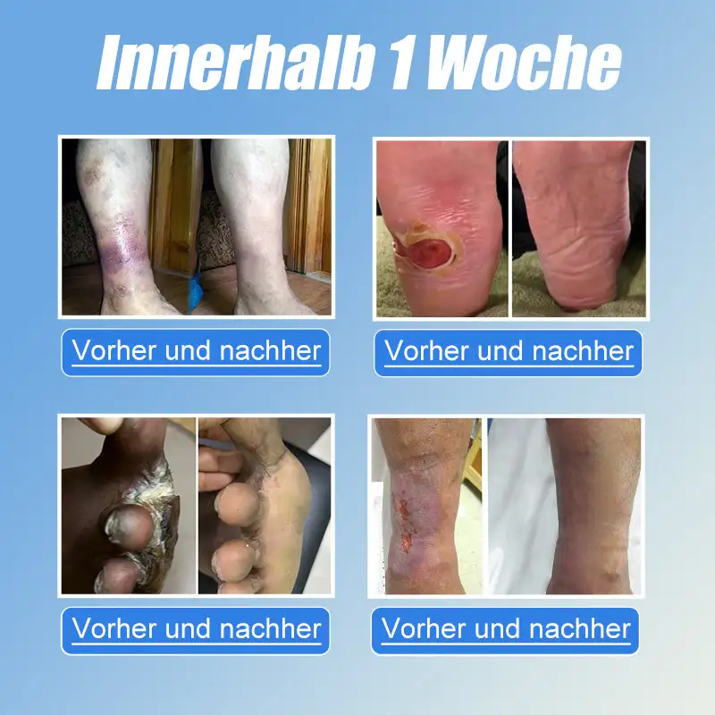 JORONDY® VitaGluco Diabetes Treatment Cream