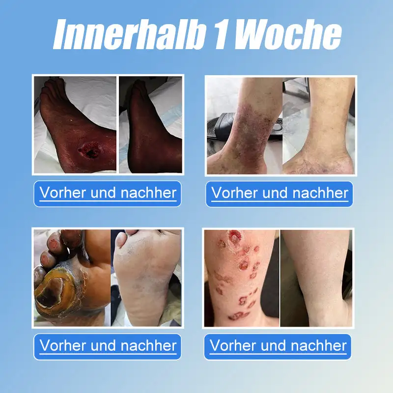 JORONDY® VitaGluco Diabetes Treatment Cream