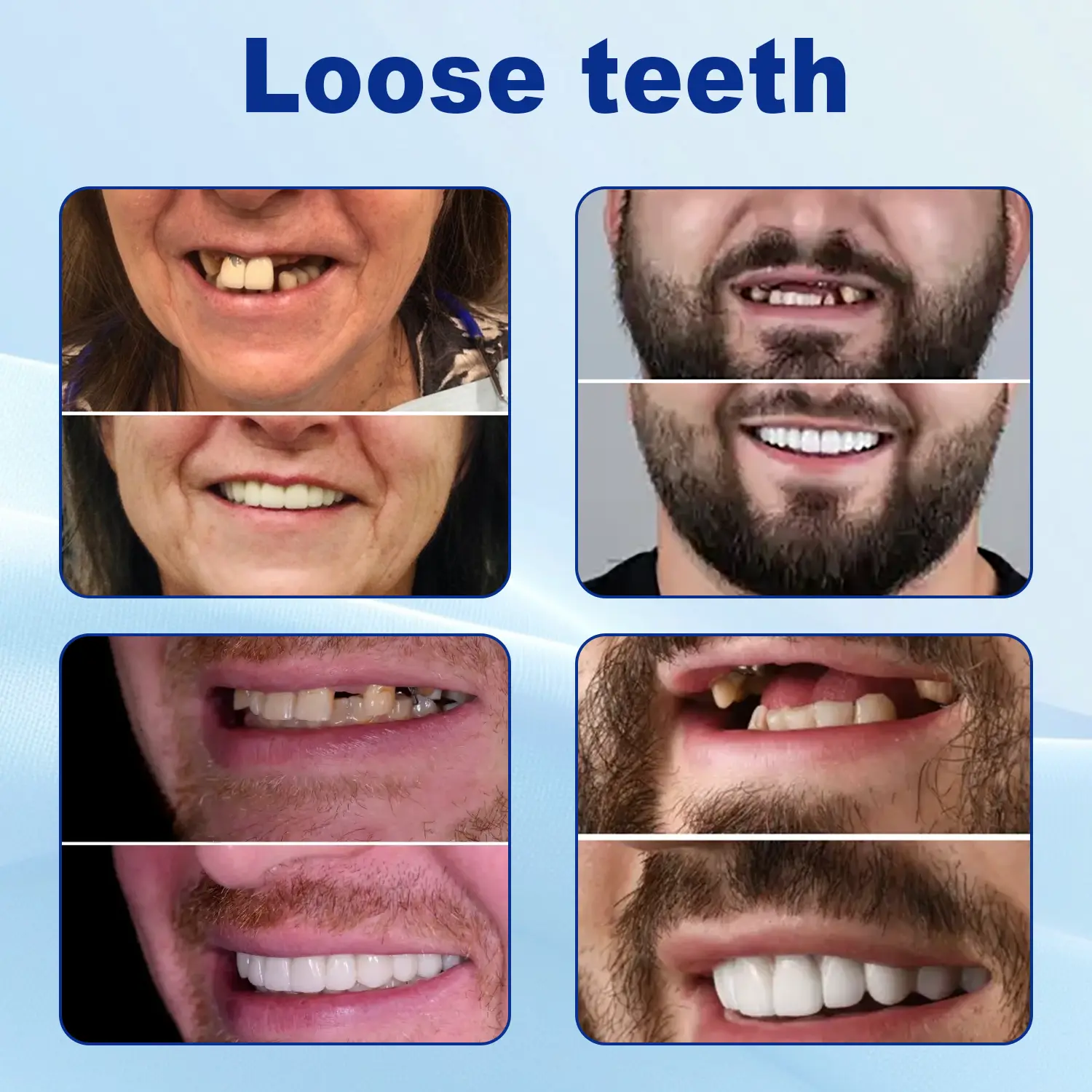 Nurbini™ Advanced Customized Full Denture Set