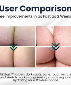 SilkiBum™ Butt Skin Treatment Cream