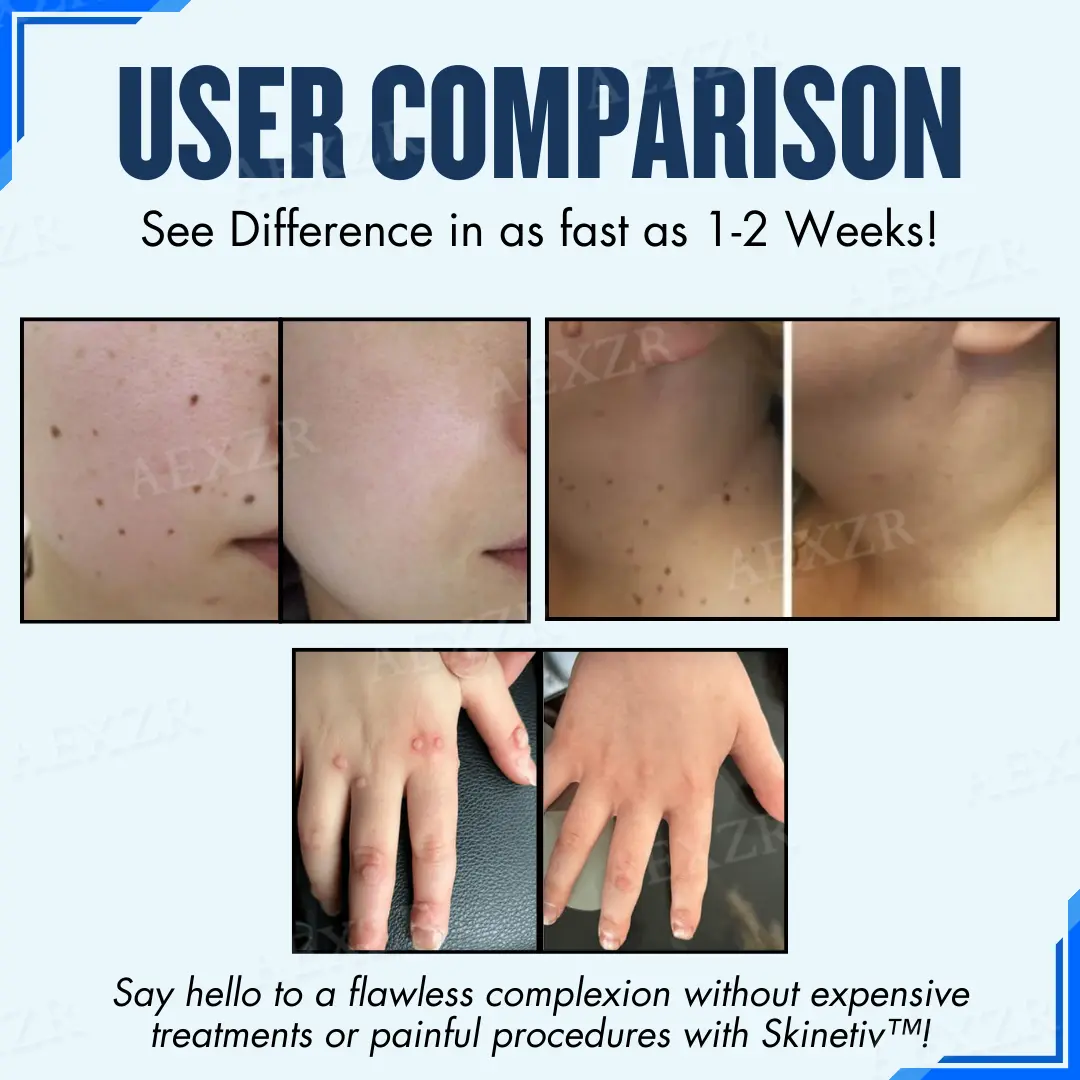 Skinetiv™ пластир за премахване на бенки и брадавици