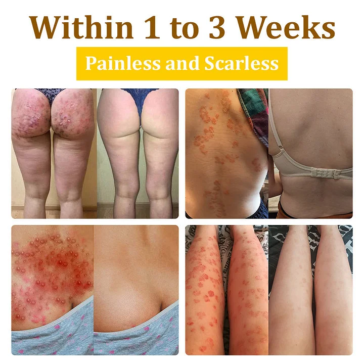 Haplos™ Bee Venom Treatment Cream - Image 12