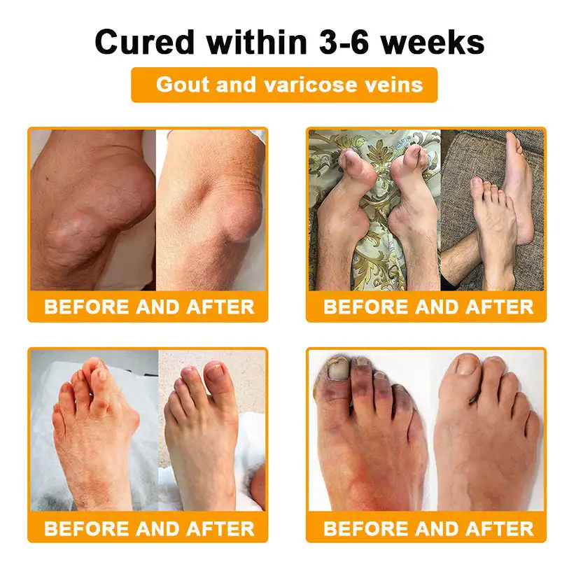 Daasry™ Botulinum Toxin & Bee Venom Pain-Relief Bone Healing Cream