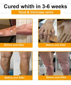 Daasry™ Botulinum Toxin & Bee Venom Pain-Relief Bone Healing Cream