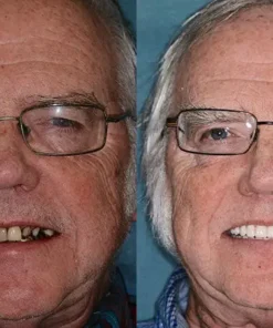 HZA™ Advanced Customized Full Denture Set