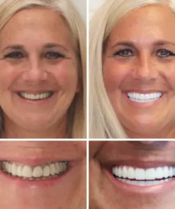 HZA™ --🦷Advanced Customized Full Denture Set🦷