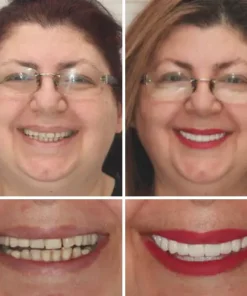 HZA™ --🦷Advanced Customized Full Denture Set🦷