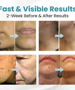 JEREMYTIS® Non-Invasive Mole and Wart Removal Laser Pen