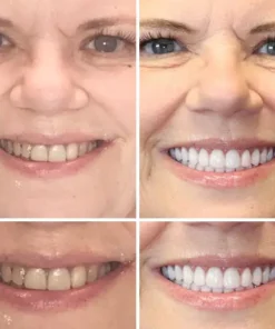 Natravor™ - Dentadura Premium