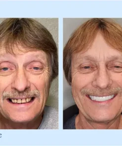 Neslemy™ - Premium Denture