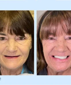 Neslemy™ - Premium Denture