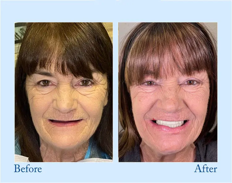 Neslemy™ - Premium Denture