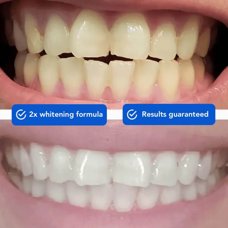 OneiasSmile™ Dissolvable Teeth Whitening Strips