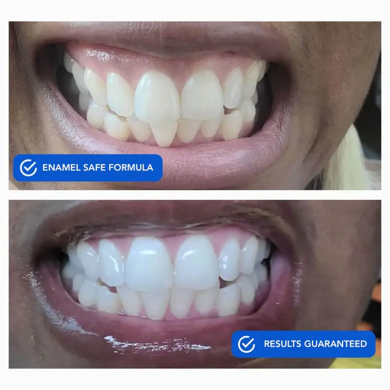 OneiasSmile™ Dissolvable Teeth Whitening Strips