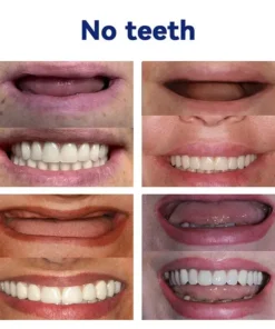 SmileFitPro™-New Generation Flexible Full Denture Solution