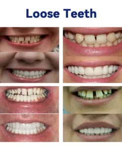 SmileFitPro™-New Generation Flexible Full Denture Solution