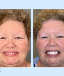 Smileasego™ - Premium Denture