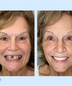 Smileasego™ - Premium Denture