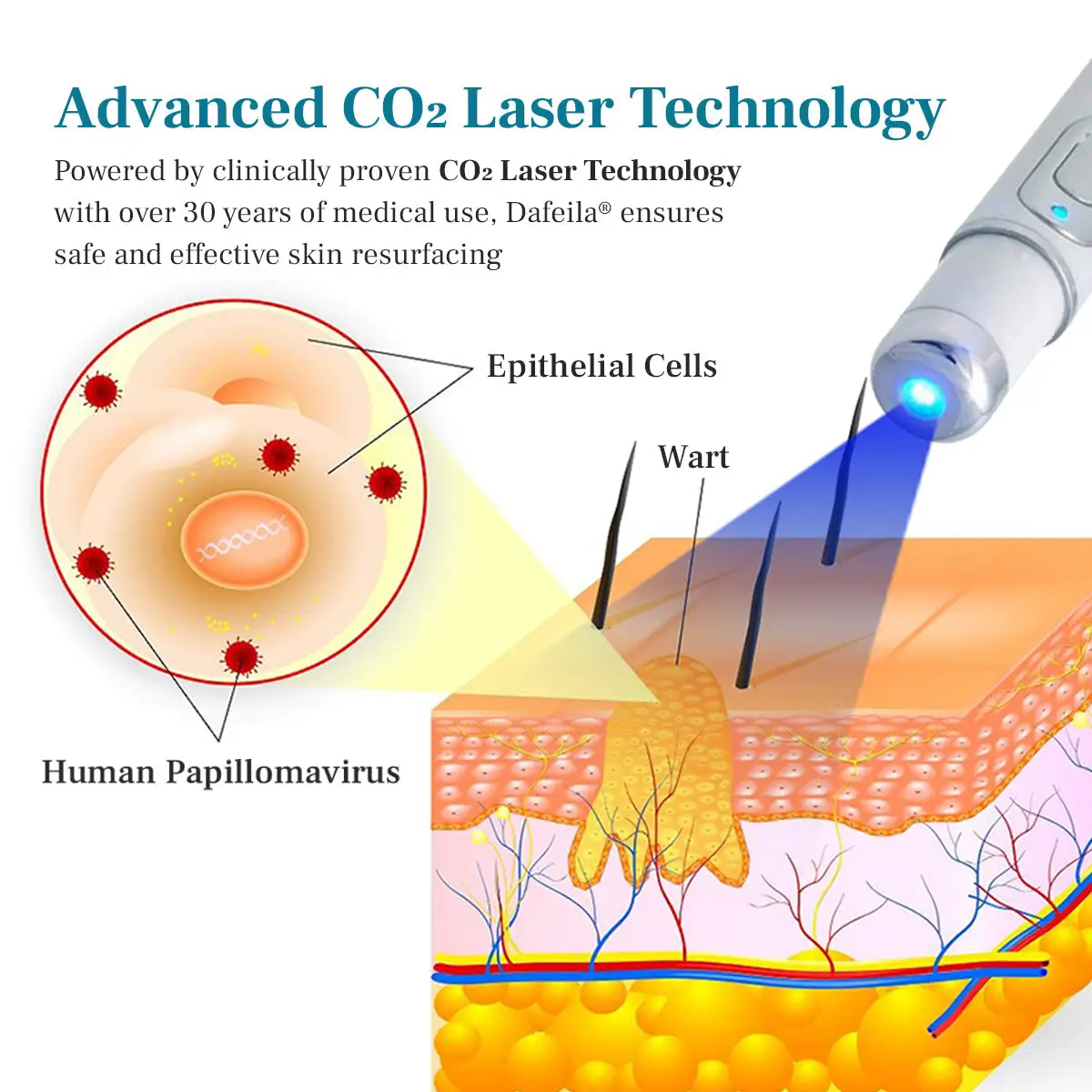 DAFEILA® LumeSkin Mole and Wart Removal Laser Pen