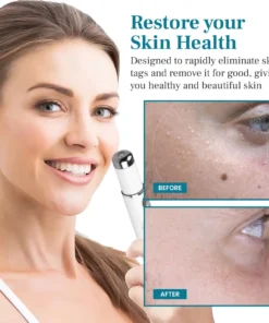 DAFEILA® LumeSkin Mole and Wart Removal Laser Pen