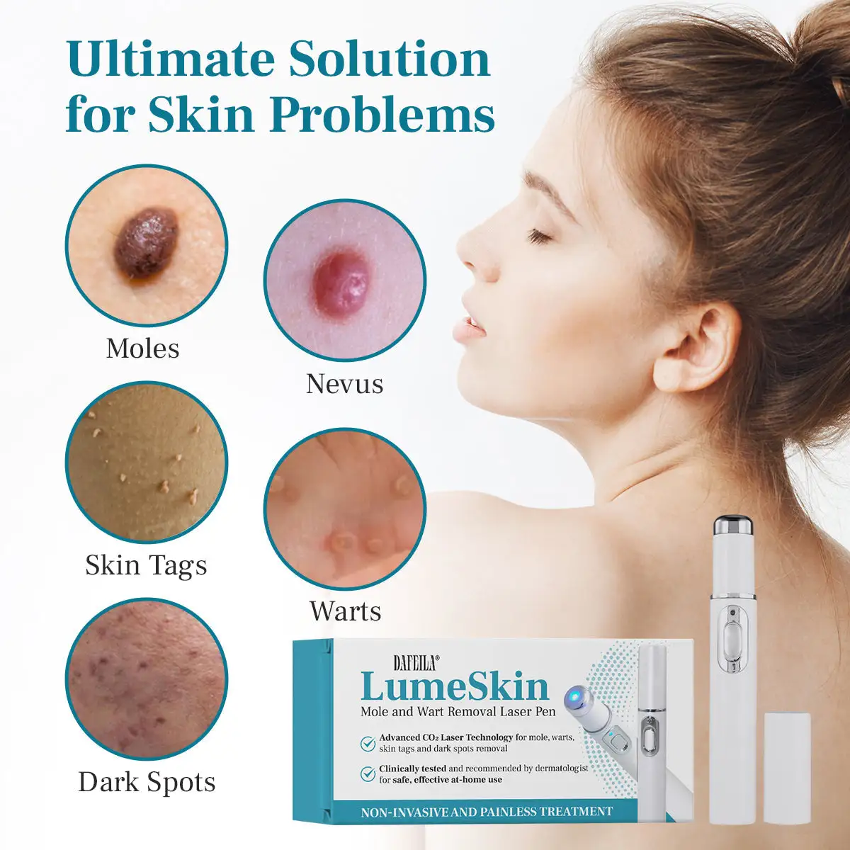 DAFEILA® LumeSkin Mole and Wart Removal Laser Pen
