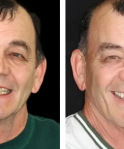 HOOMWELL™ --🦷Advanced Customized Full Denture Set🦷