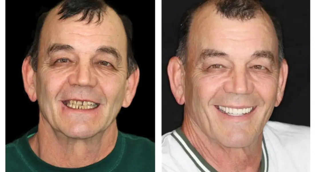 HOOMWELL™ --🦷Advanced Customized Full Denture Set🦷