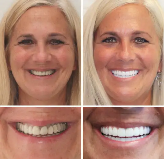 HOOMWELL™ --🦷Advanced Customized Full Denture Set🦷