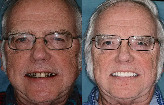 HOOMWELL™ --🦷Advanced Customized Full Denture Set🦷